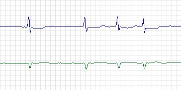 Electrocardiogram for PAF Prediction Challenge, record p50c