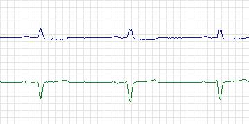 Electrocardiogram for PAF Prediction Challenge, record t05