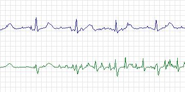 Electrocardiogram for PAF Prediction Challenge, record t09