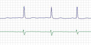 Electrocardiogram for PAF Prediction Challenge, record t13