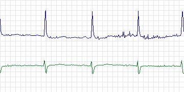Electrocardiogram for PAF Prediction Challenge, record t14