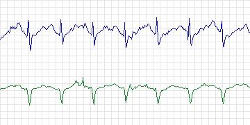 Electrocardiogram for PAF Prediction Challenge, record t15