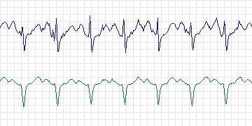 Electrocardiogram for PAF Prediction Challenge, record t16
