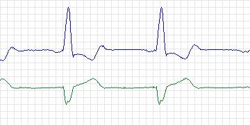 Electrocardiogram for PAF Prediction Challenge, record t19