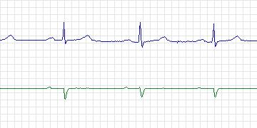 Electrocardiogram for PAF Prediction Challenge, record t21