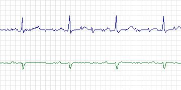 Electrocardiogram for PAF Prediction Challenge, record t22