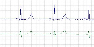 Electrocardiogram for PAF Prediction Challenge, record t23