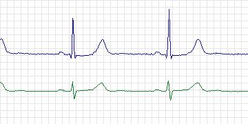 Electrocardiogram for PAF Prediction Challenge, record t24
