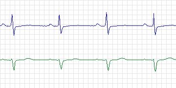 Electrocardiogram for PAF Prediction Challenge, record t87