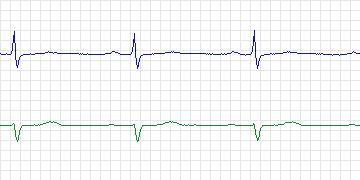 Electrocardiogram for PAF Prediction Challenge, record t88