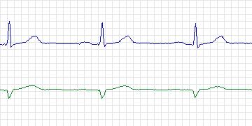 Electrocardiogram for PAF Prediction Challenge, record t89