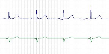 Electrocardiogram for PAF Prediction Challenge, record t93