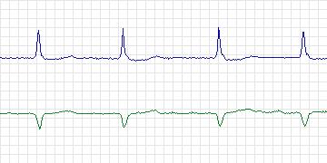 Electrocardiogram for AF Termination Challenge, record a10