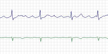 Electrocardiogram for AF Termination Challenge, record a18