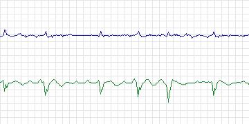 Electrocardiogram for AF Termination Challenge, record a19