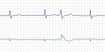 Electrocardiogram for AF Termination Challenge, record a20