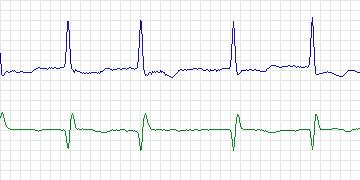 Electrocardiogram for AF Termination Challenge, record a21