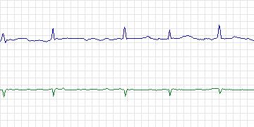 Electrocardiogram for AF Termination Challenge, record a22