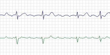 Electrocardiogram for AF Termination Challenge, record a23