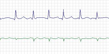 Electrocardiogram for AF Termination Challenge, record a25