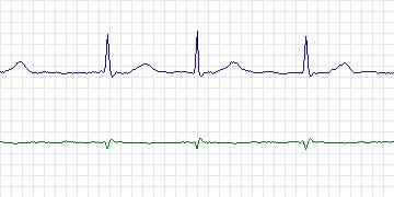 Electrocardiogram for AF Termination Challenge, record a26