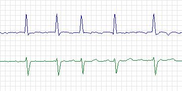 Electrocardiogram for AF Termination Challenge, record b07