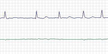 Electrocardiogram for AF Termination Challenge, record b19