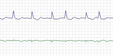 Electrocardiogram for AF Termination Challenge, record b20