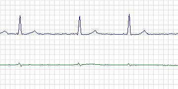 Electrocardiogram for AF Termination Challenge, record n01