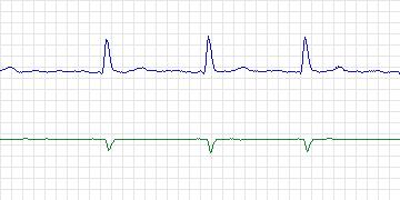 Electrocardiogram for AF Termination Challenge, record n02