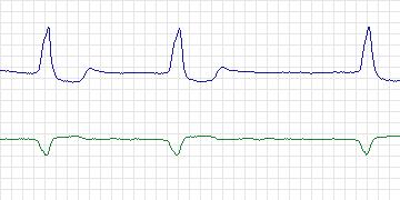 Electrocardiogram for AF Termination Challenge, record n03