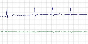 Electrocardiogram for AF Termination Challenge, record n05