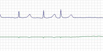 Electrocardiogram for AF Termination Challenge, record n06