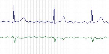 Electrocardiogram for AF Termination Challenge, record n07