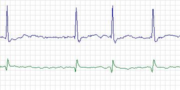 Electrocardiogram for AF Termination Challenge, record n10