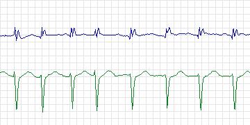 Electrocardiogram for AF Termination Challenge, record s01