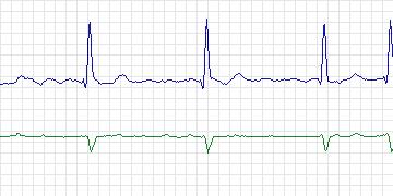 Electrocardiogram for AF Termination Challenge, record s04