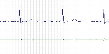 Electrocardiogram for AF Termination Challenge, record s05