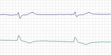 Electrocardiogram for MIT-BIH ECG Compression Test, record 08730_01