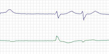 Electrocardiogram for MIT-BIH ECG Compression Test, record 08730_02