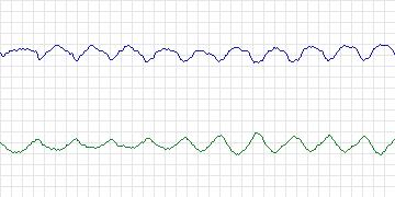 Electrocardiogram for MIT-BIH ECG Compression Test, record 08730_03