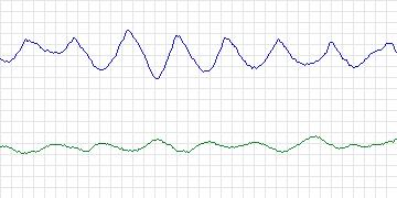Electrocardiogram for MIT-BIH ECG Compression Test, record 08730_04