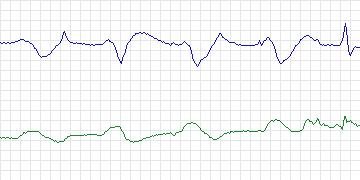 Electrocardiogram for MIT-BIH ECG Compression Test, record 08730_05