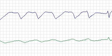 Electrocardiogram for MIT-BIH ECG Compression Test, record 08730_06
