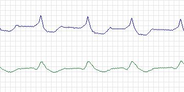 Electrocardiogram for MIT-BIH ECG Compression Test, record 08730_07