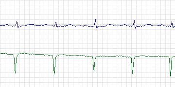 Electrocardiogram for MIT-BIH ECG Compression Test, record 11442_01