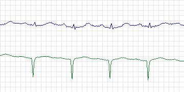 Electrocardiogram for MIT-BIH ECG Compression Test, record 11442_02