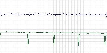 Electrocardiogram for MIT-BIH ECG Compression Test, record 11442_03