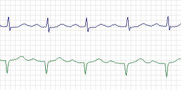 Electrocardiogram for MIT-BIH ECG Compression Test, record 11442_04
