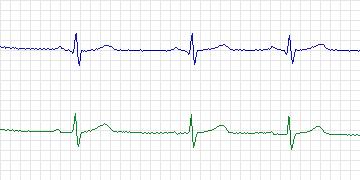 Electrocardiogram for MIT-BIH ECG Compression Test, record 11950_01